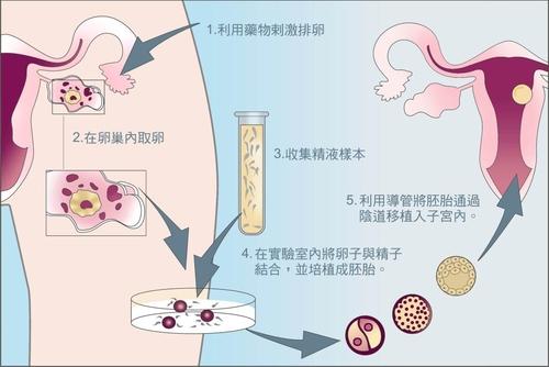 厦门试管婴儿包生男孩-江苏省内可以做试管婴儿的医院